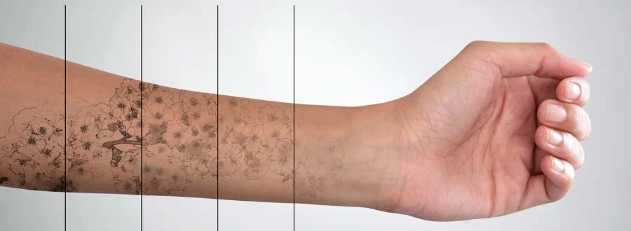 Tatouage qui s’estompe au fil des séances de détatouage