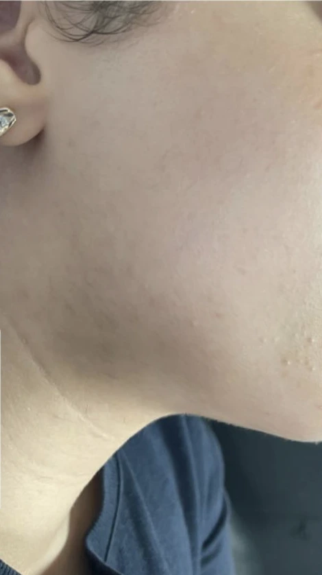 Joues et mâchoire, après