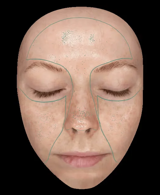 Rapport : pores