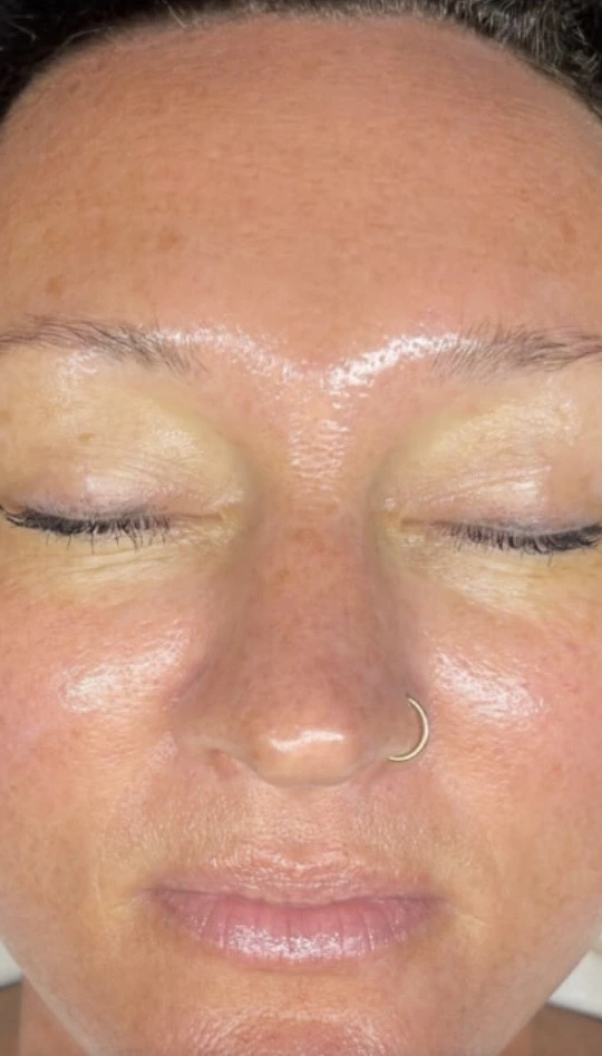Visage après 2 séances d’hydrodermabrasion