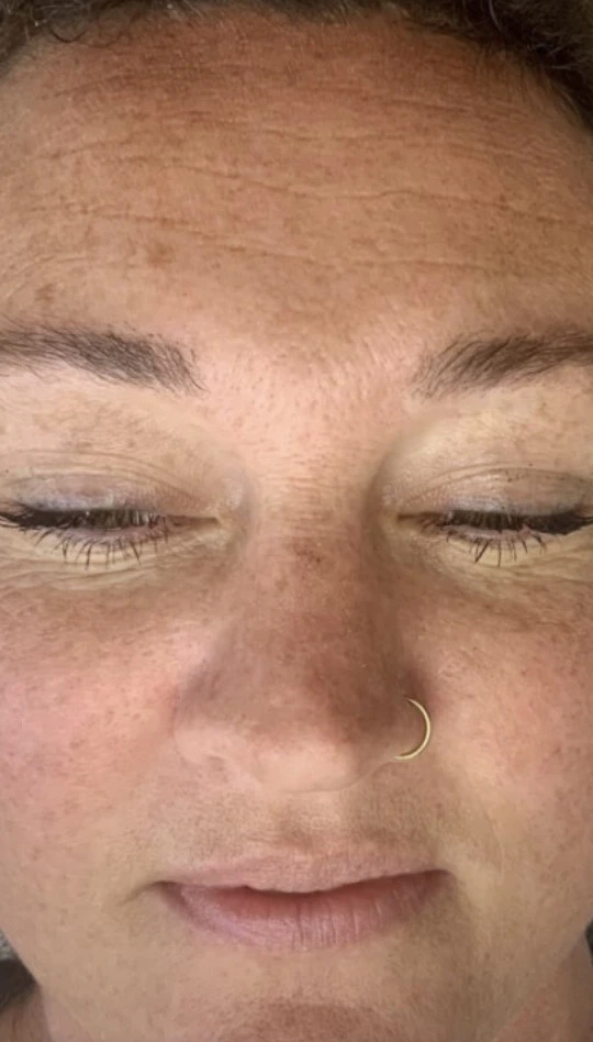 Visage avant l’hydrodermabrasion