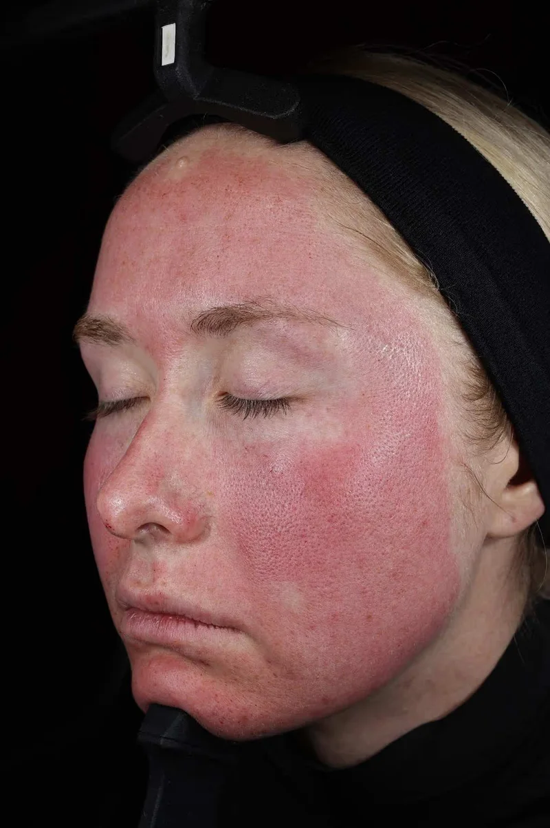 Peau une heure après la séance SkinPen
