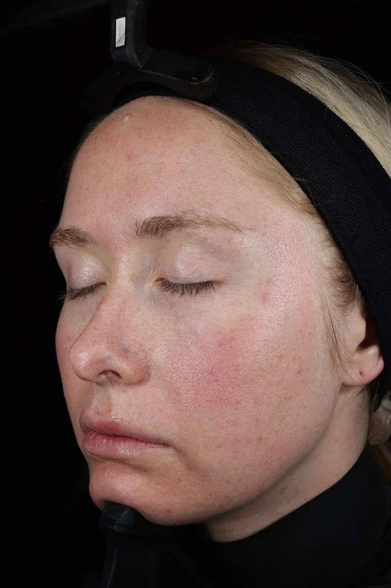 Peau vingt-quatre heures après la séance SkinPen